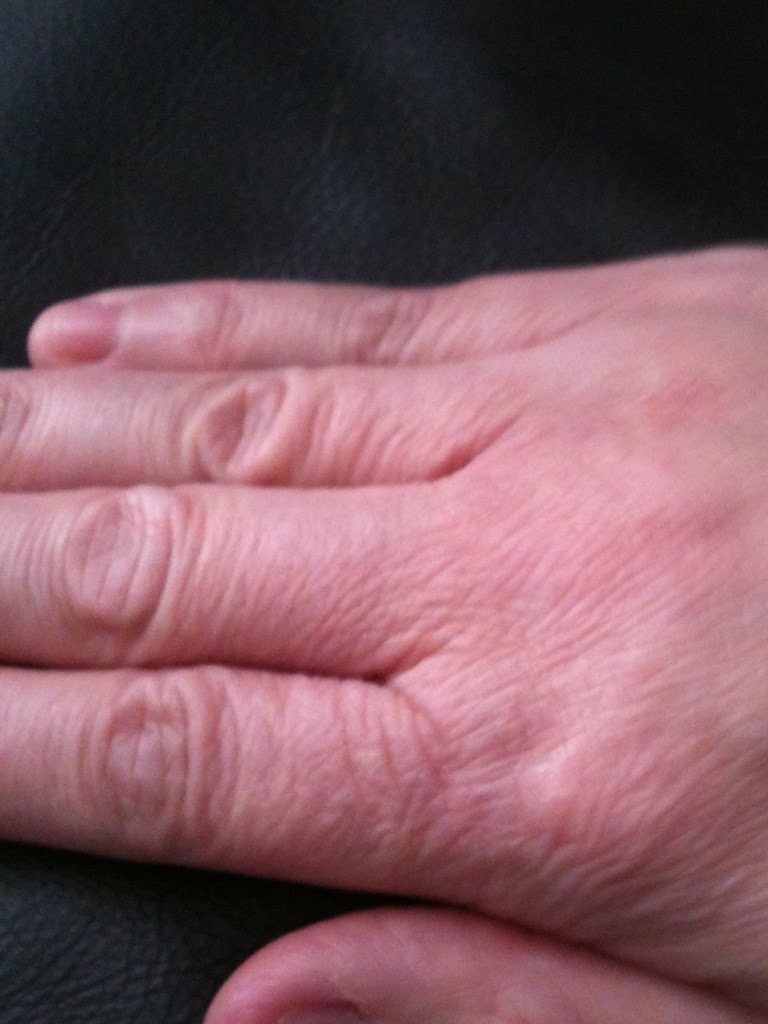 dry and cracked hands