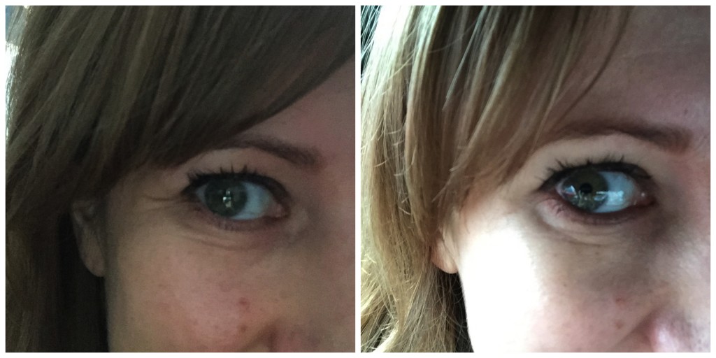 non-surgical treatments before and after 1